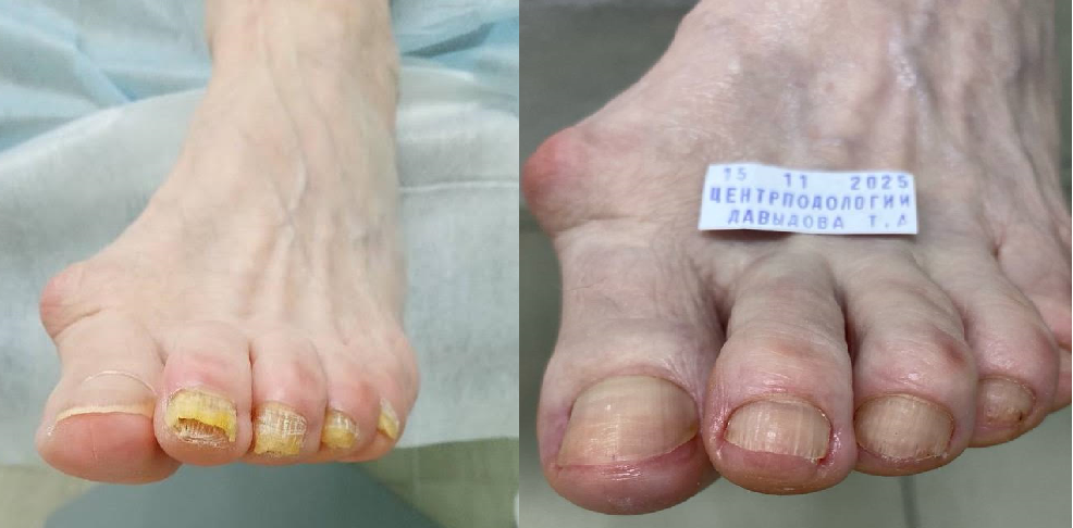 Грибок ногтя до начала работ подолога и в процессе выведения грибка