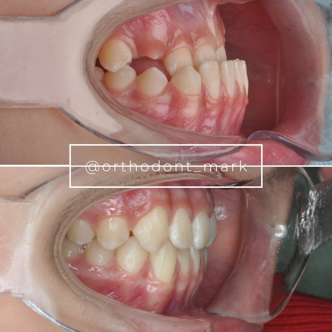 Correcting Mesial Occlusion and Anterior Crossbite With MARPE
