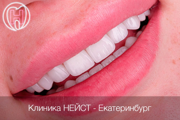 керамические виниры цвет Блич 2 (Bleach2)