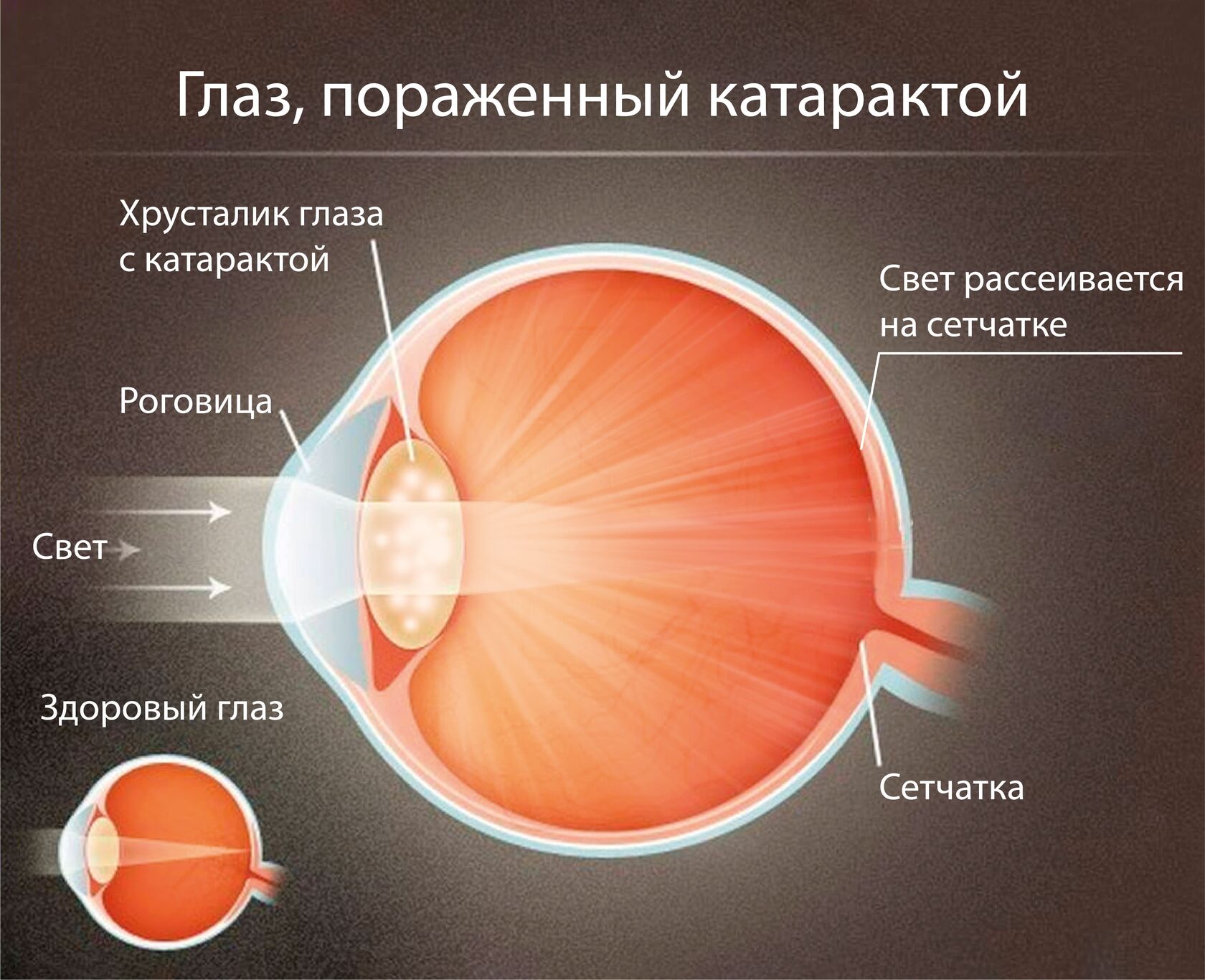 Астигматизм Лечение У Взрослых Лазером Цена