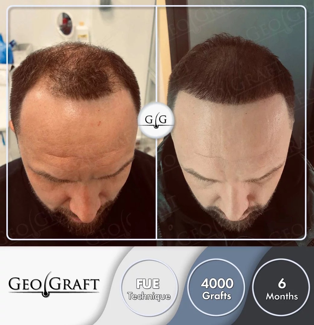 Пересадка волос в Москве. Geograft. Без боли - за один день.