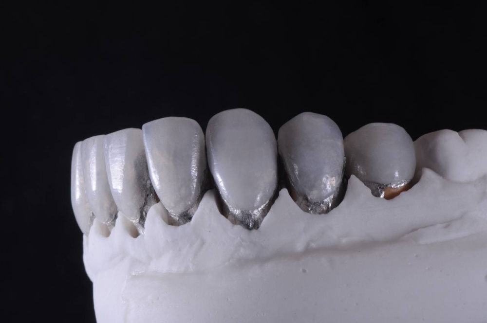 Dental porcelain veneers Miami, FL cost