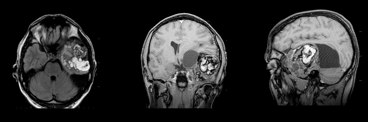 Тератома - Диагностика и лечение