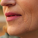 rf-лифтинг лица