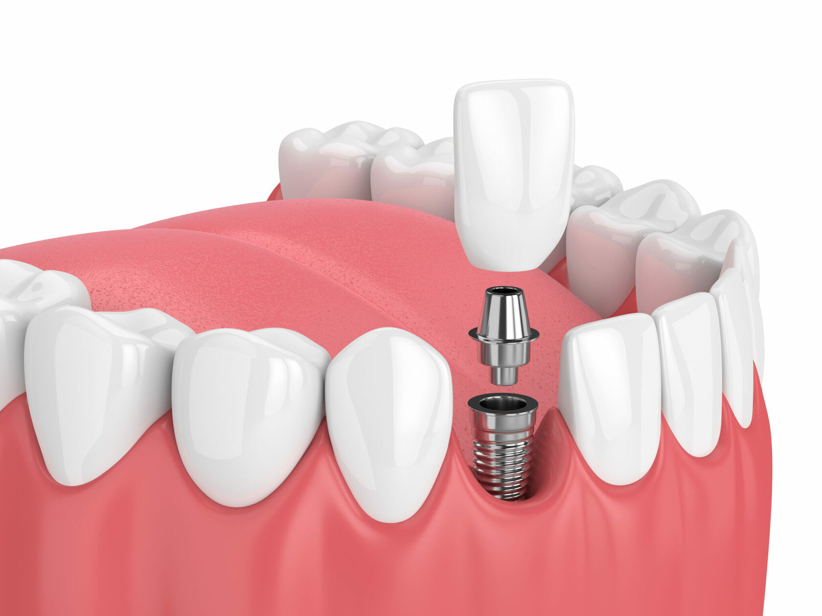 Стоматология имплантация зубов