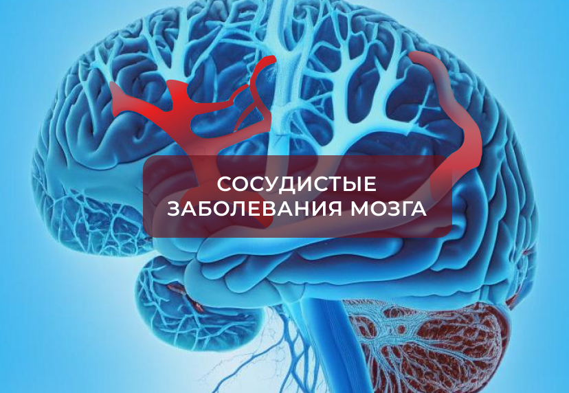 Заболевания сосудов головного мозга и шеи