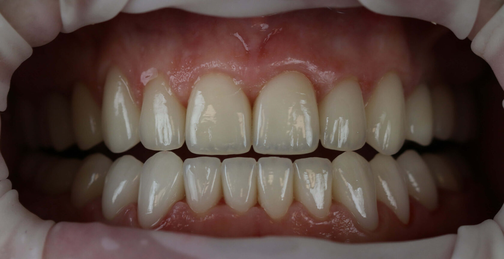 Установка керамических виниров пациенту клиники Пробел в Москве