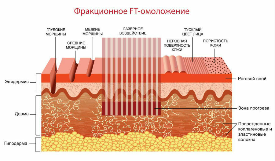 Воздействие фракционного лазера на кожу