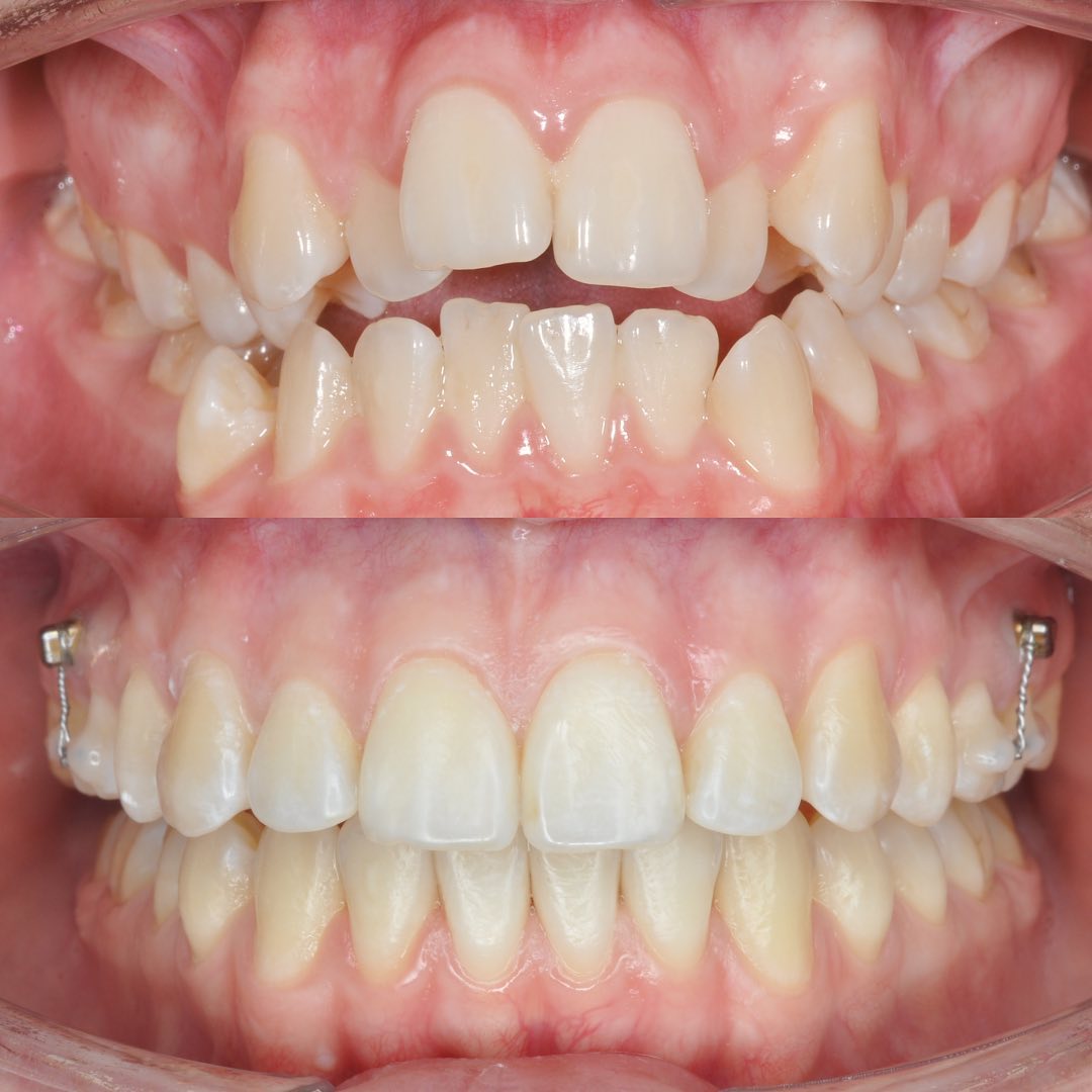 Before treatment view of the narrow maxillary arch prior to non-surgical MARPE expansion
