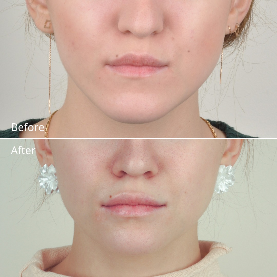 Stage showing pre-surgical orthodontic decompensation with Damon braces — photo 2 of 5