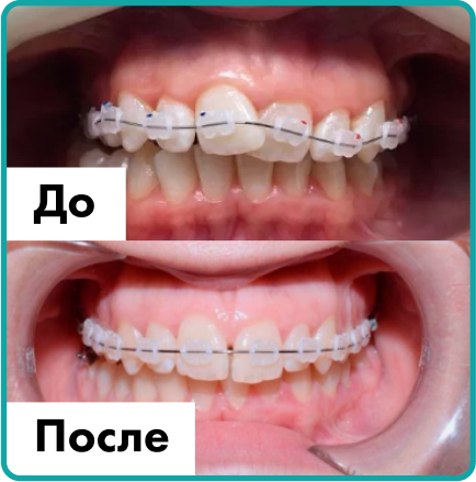 Установка имплантов в Дербенте. Имплантация при отсутствии одного зуба.