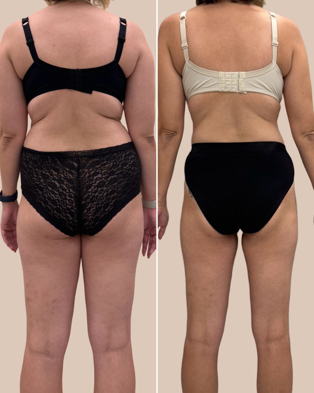 Мезотерапия тела + Циклосфера 