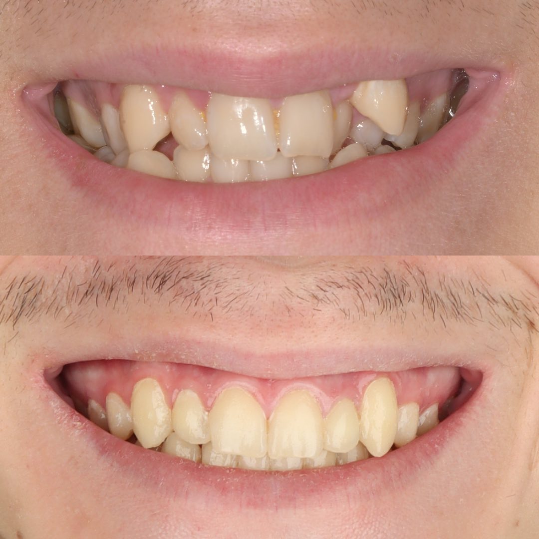 Before treatment view of the narrow maxillary arch prior to MARPE expansion