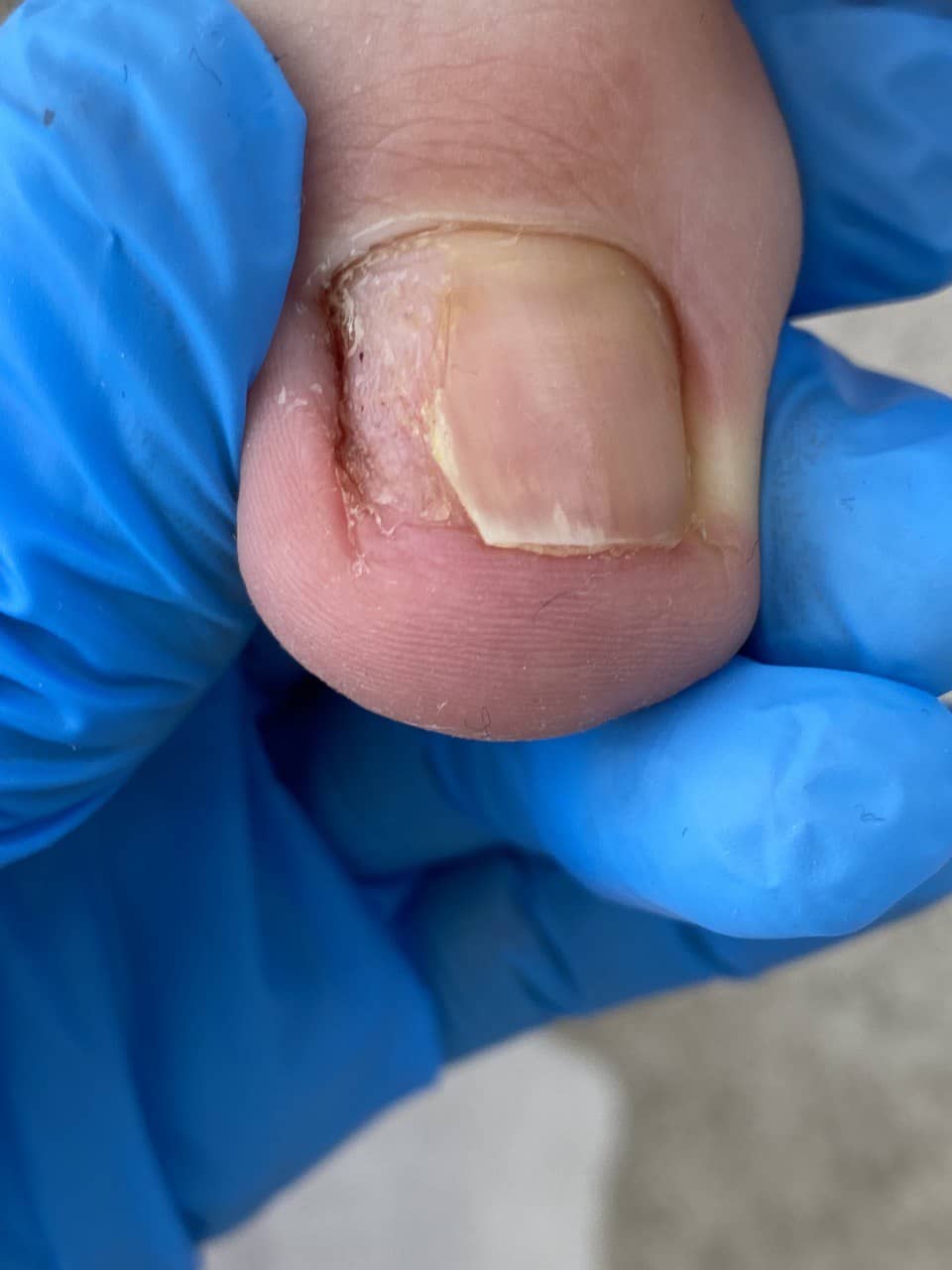 онихолизис +на руках