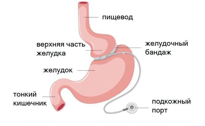 Уменьшение желудка