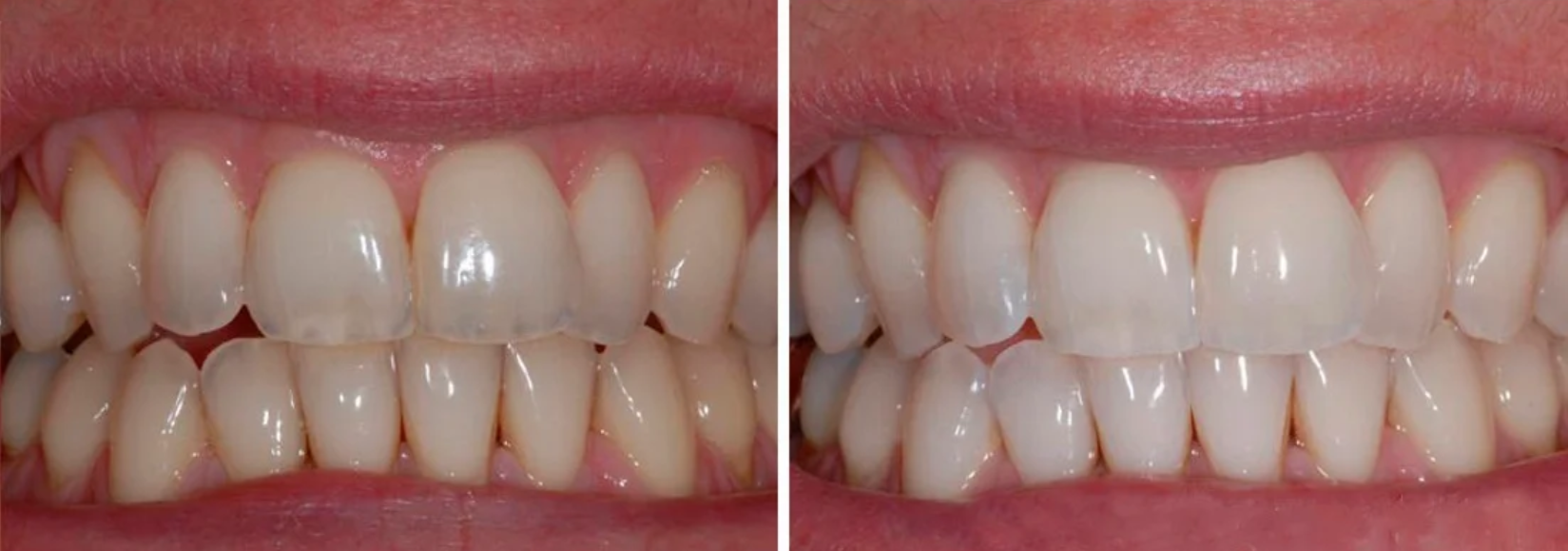 Тетрациклиновые зубы отбеливание