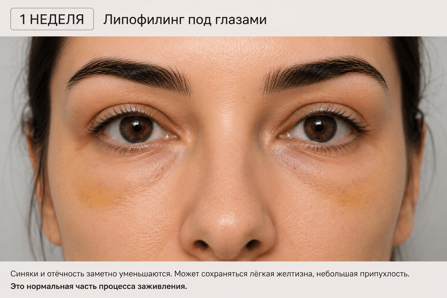 через неделю после процедуры