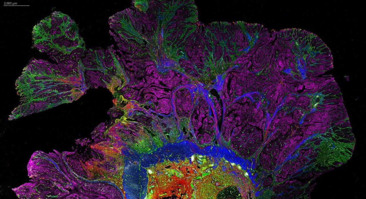 Tumour growth