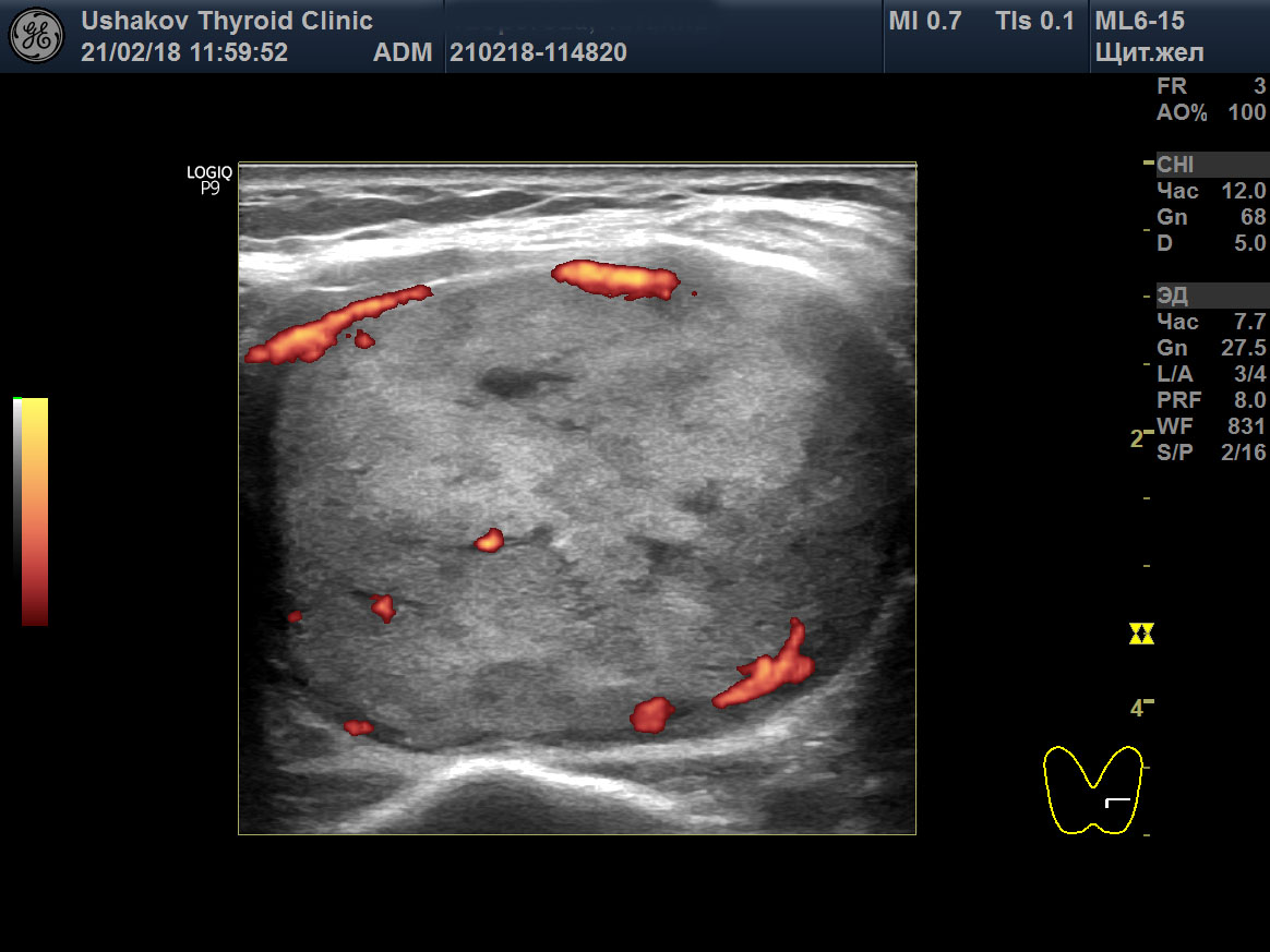 Щитовидный железа аденома. Аденома щитовидной железы на УЗИ. Фолликулярная аденома щитовидной железы УЗИ. Узел по УЗИ ti rads 2. Аденома щит железы на УЗИ.