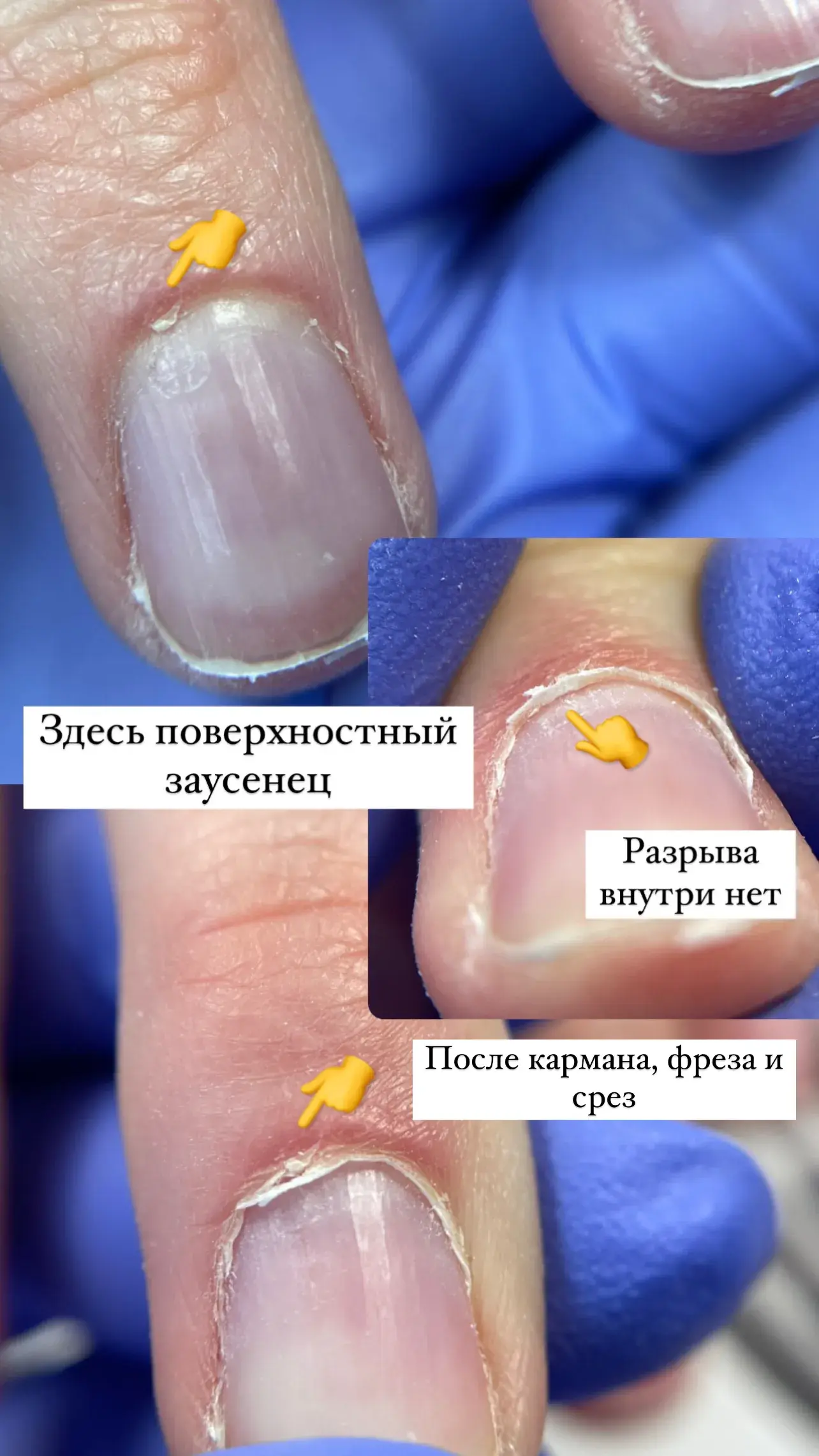 пример налипшей кутикулы и работы с ней в технике комби маникюра безопасное открытие кармана без пропилов ногтей