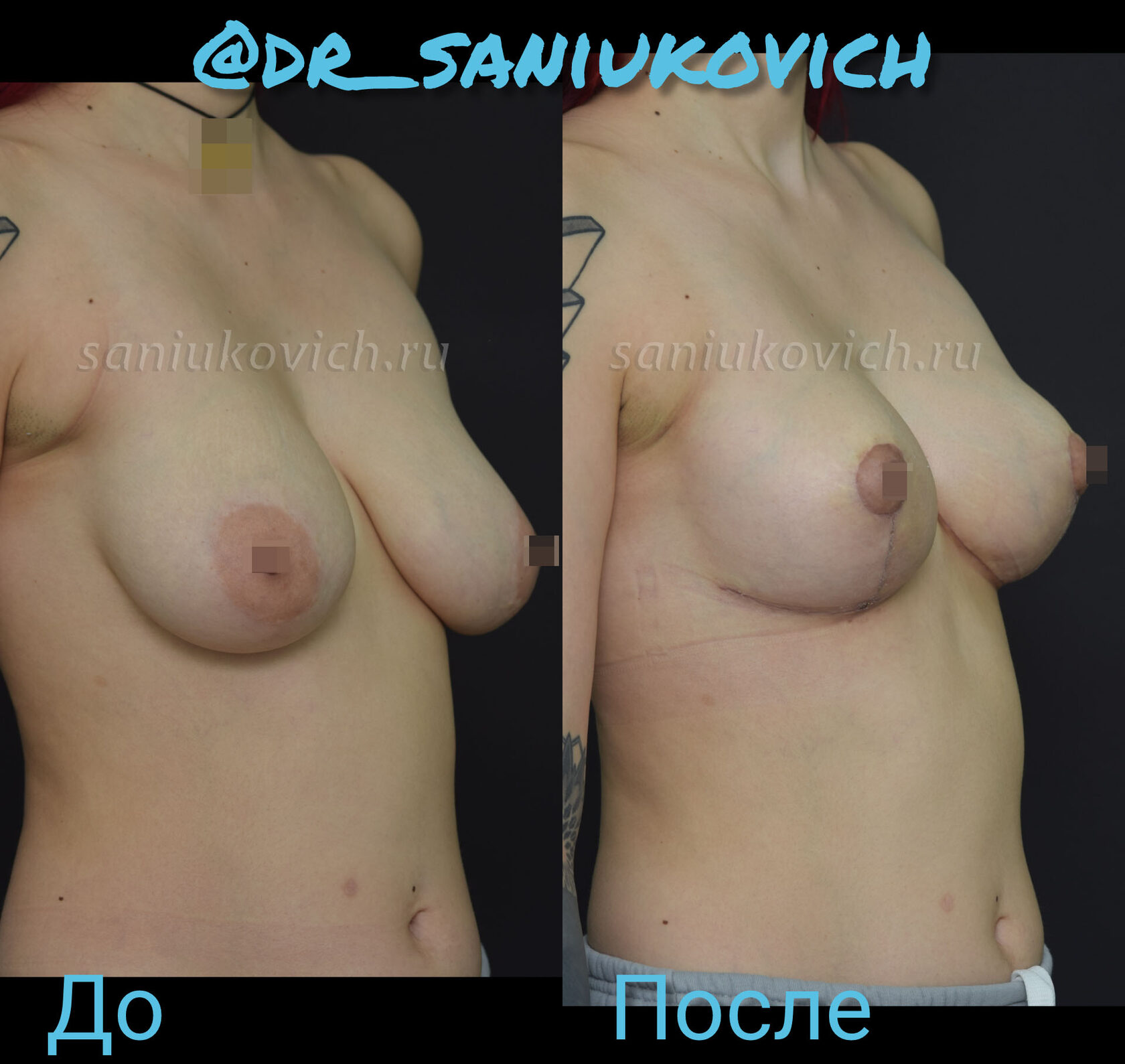 подтяжка груди женщин в домашних условиях фото 33