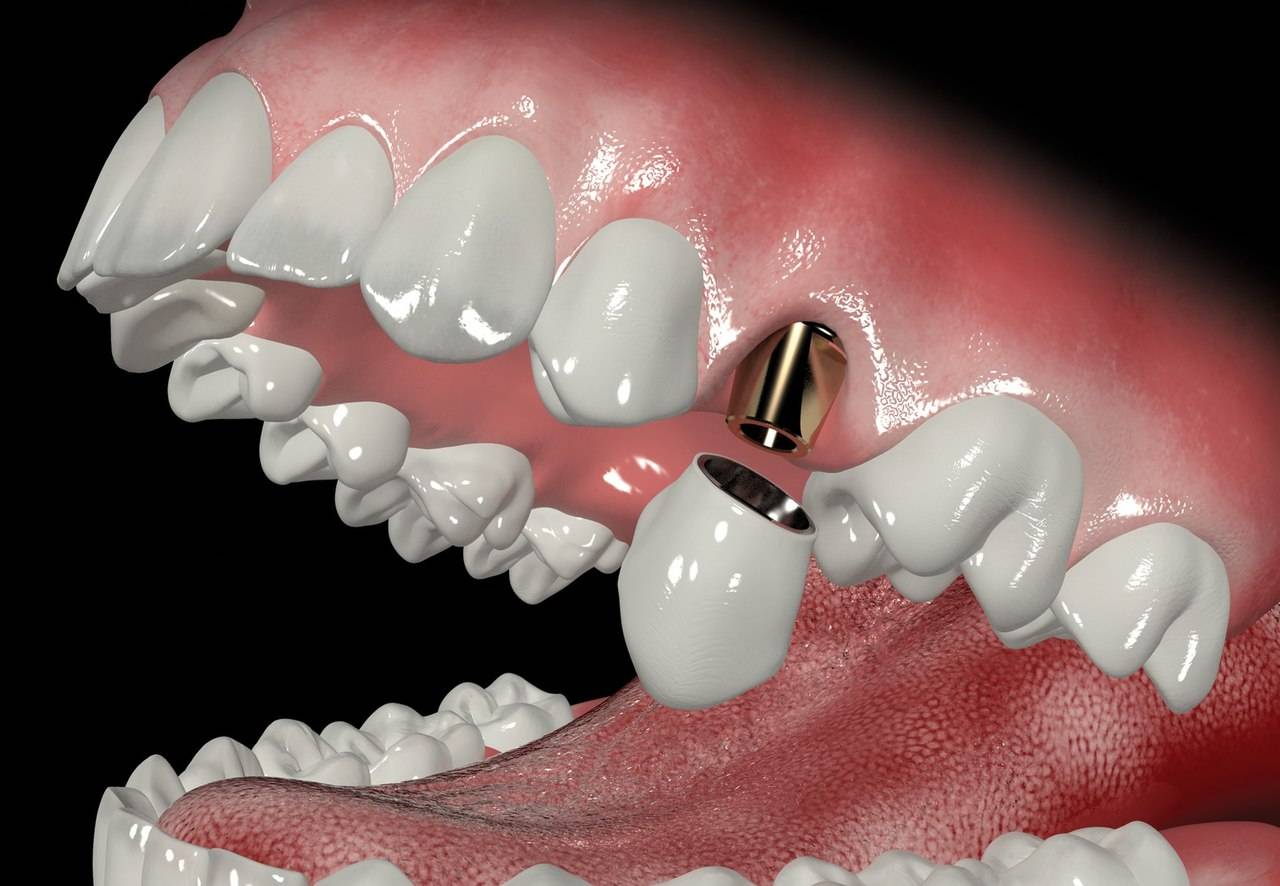 имплантация зубов краснодар