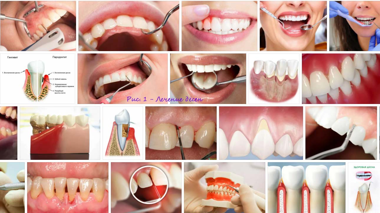 Отбеливание зубной эмали перекисью водорода
