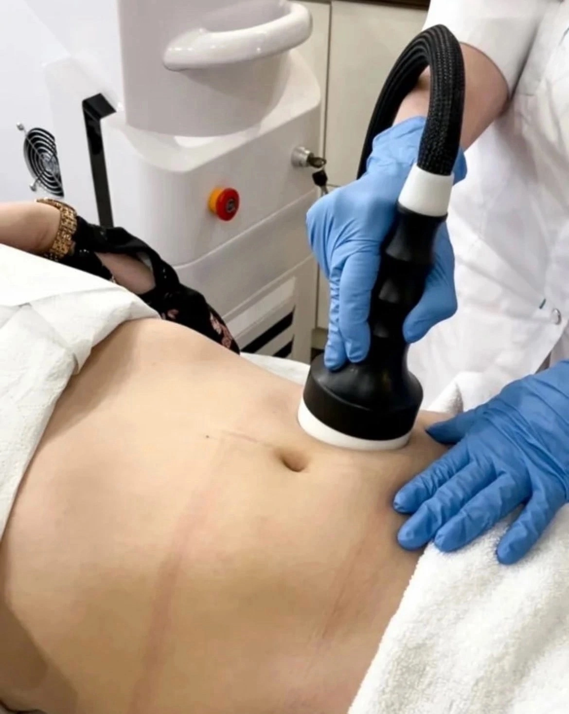 Микроволновой липолиз в студии А.М — неинвазивная коррекция контуров тела во Владимире