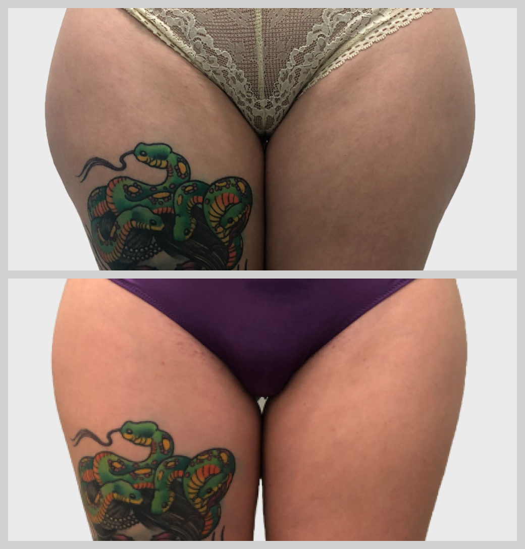 липосакция бедер 