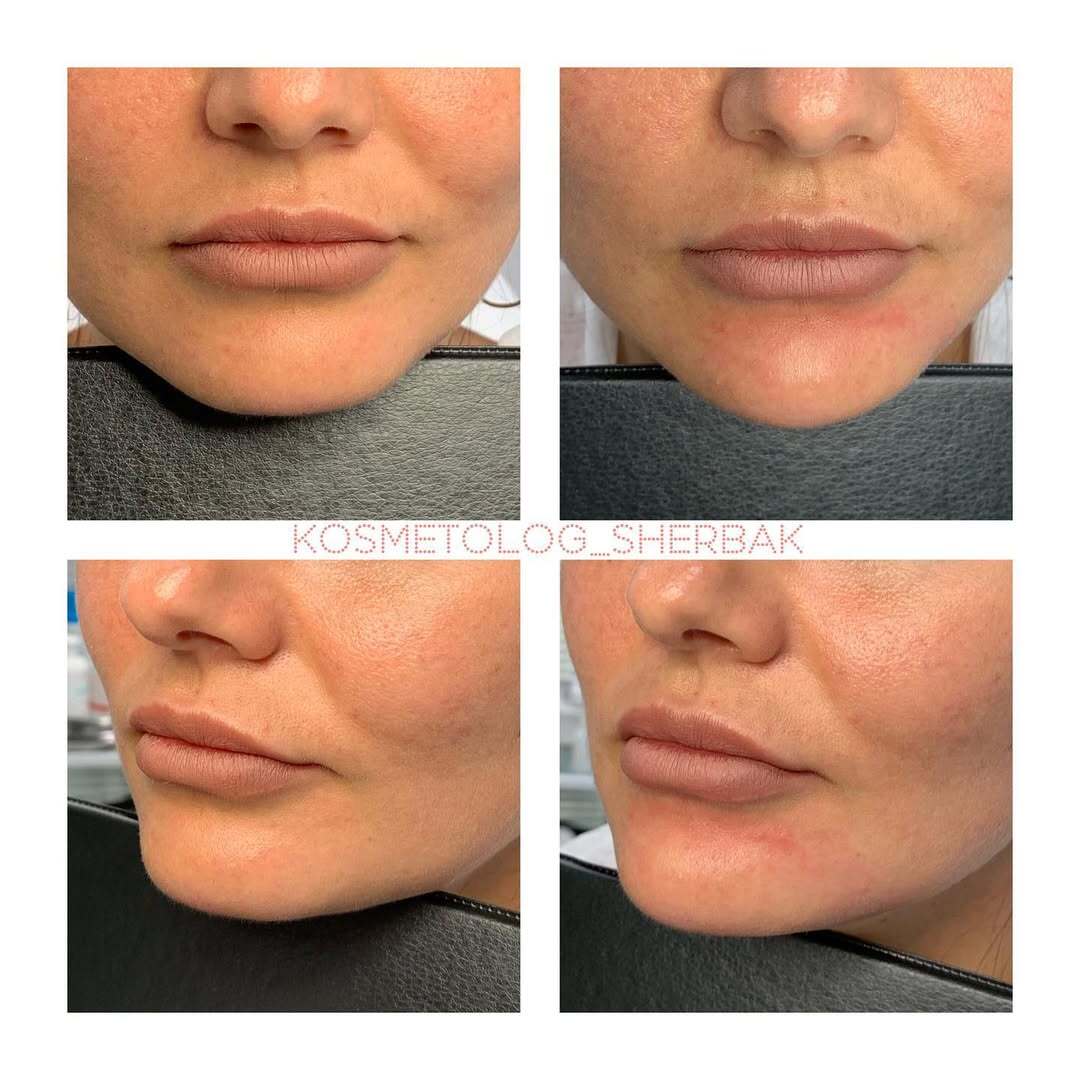 Контурная пластика лица в клинике PradusCOSMO, Санкт-Петербург. Естественный результат без эффекта переделанного лица