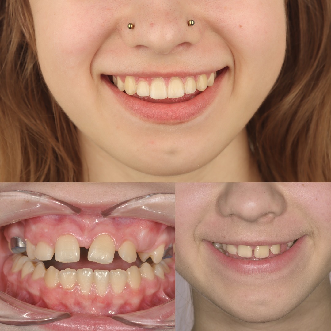 Pediatric Skeletal Expansion with MARPE and TAD-Supported Anchorage