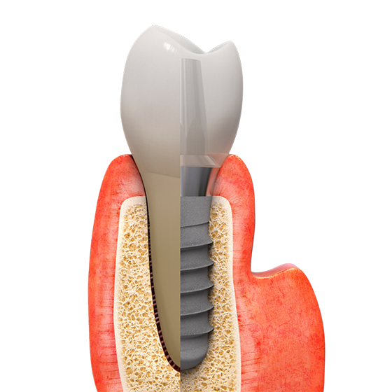 имплантация