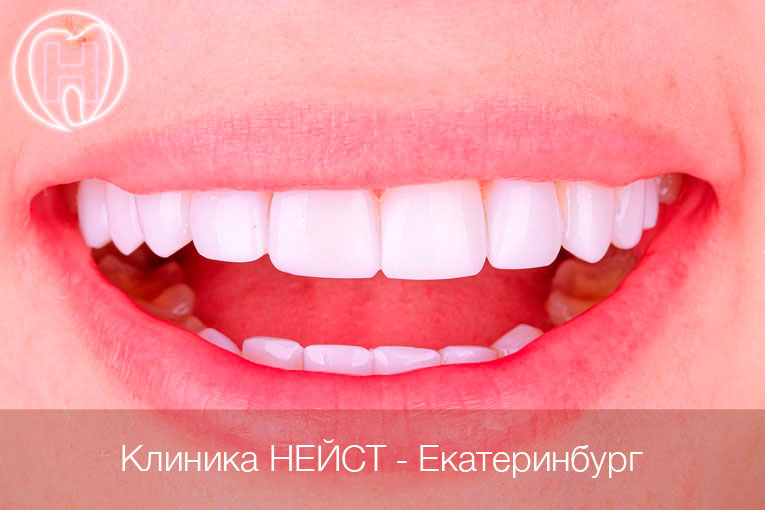 композитные виниры Стандарт в Екатеринбурге, цвет Блич 2