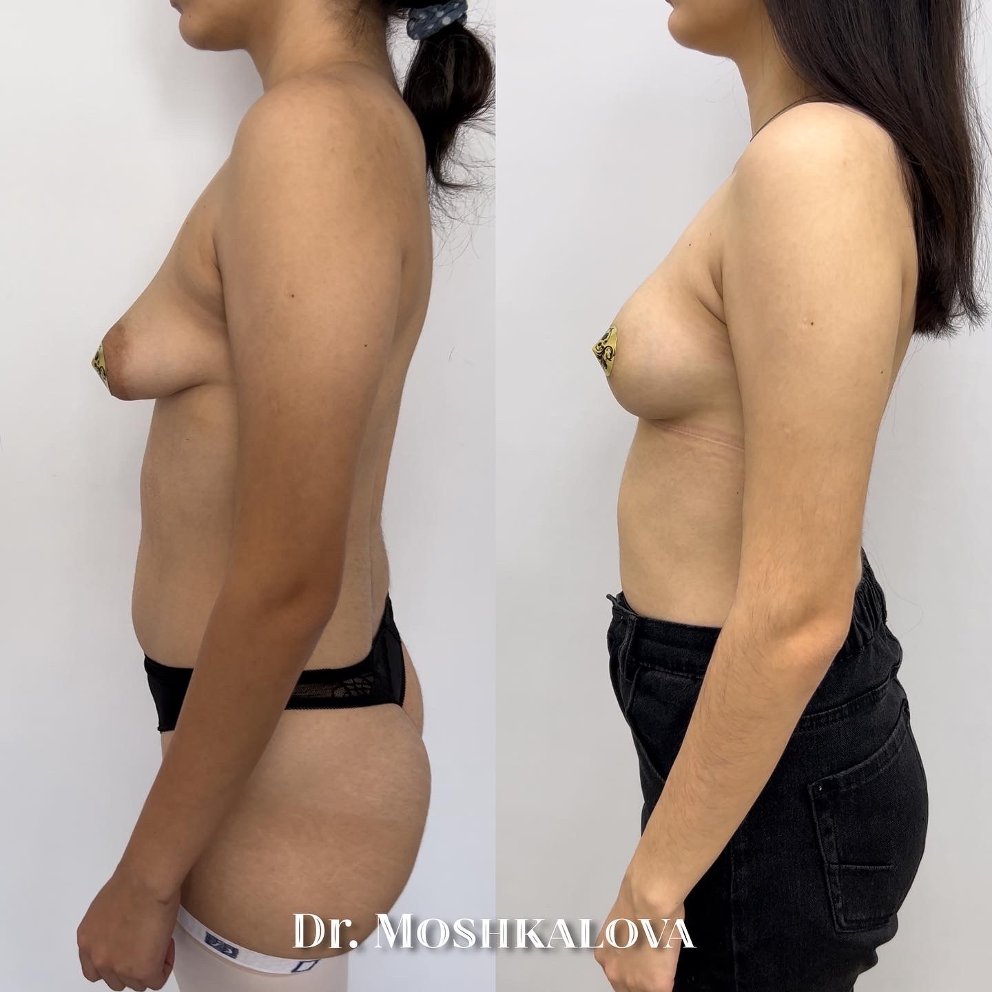 увеличилась грудь у женщин фото 17