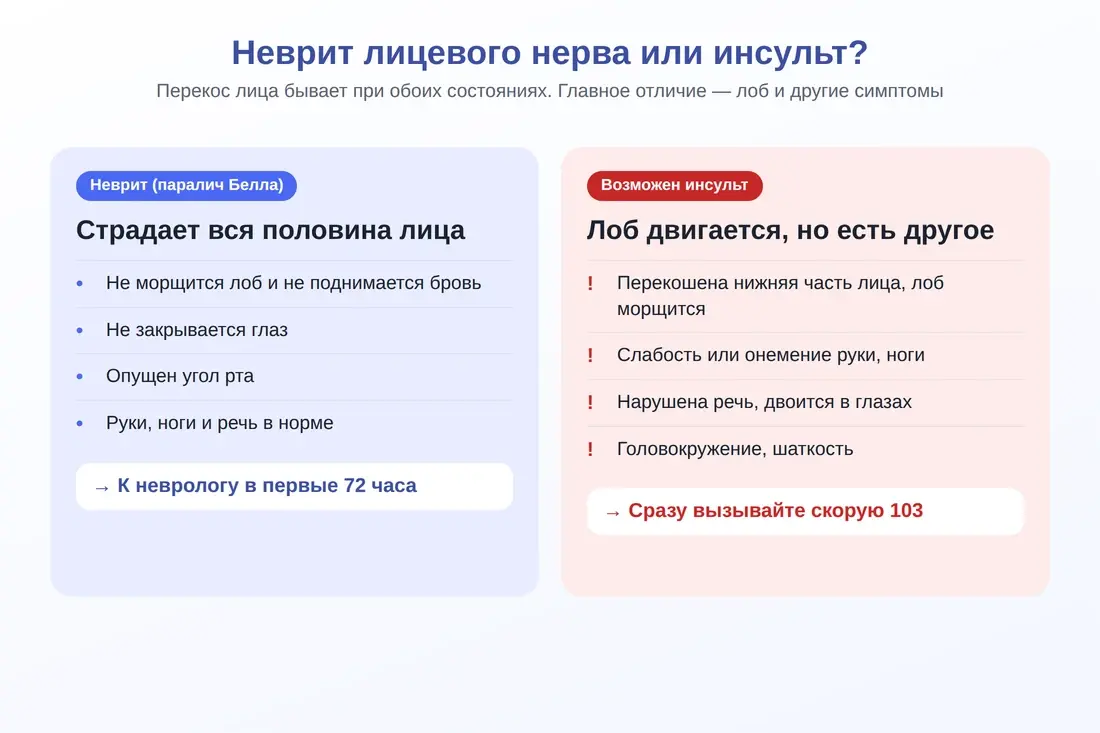 Как отличить неврит лицевого нерва от инсульта