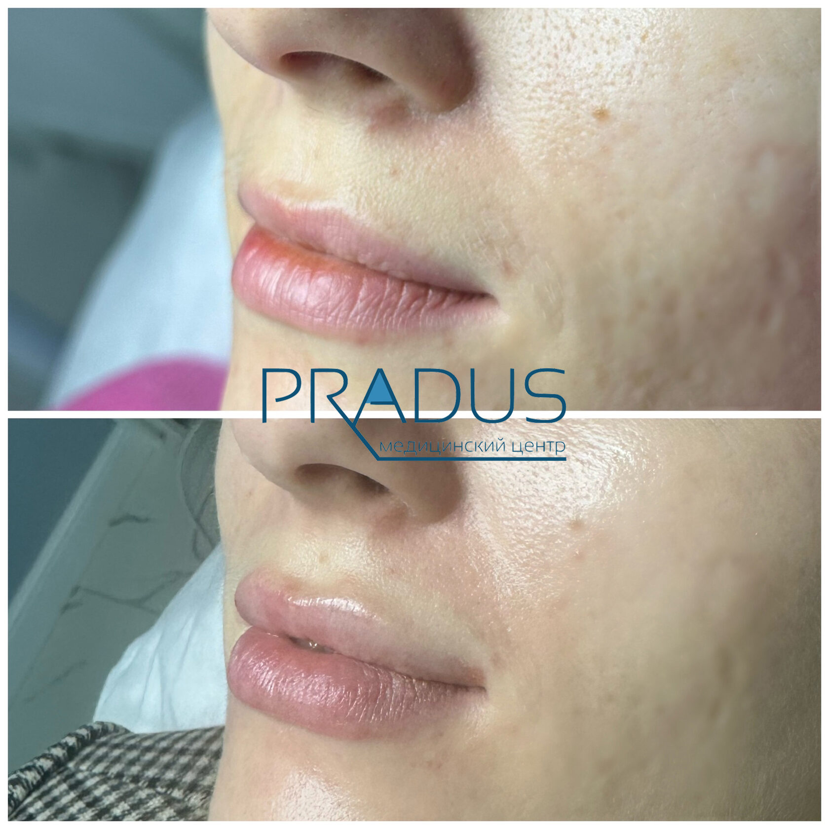 До и после контурной пластики губ. PradusCOSMO, Васильевский остров