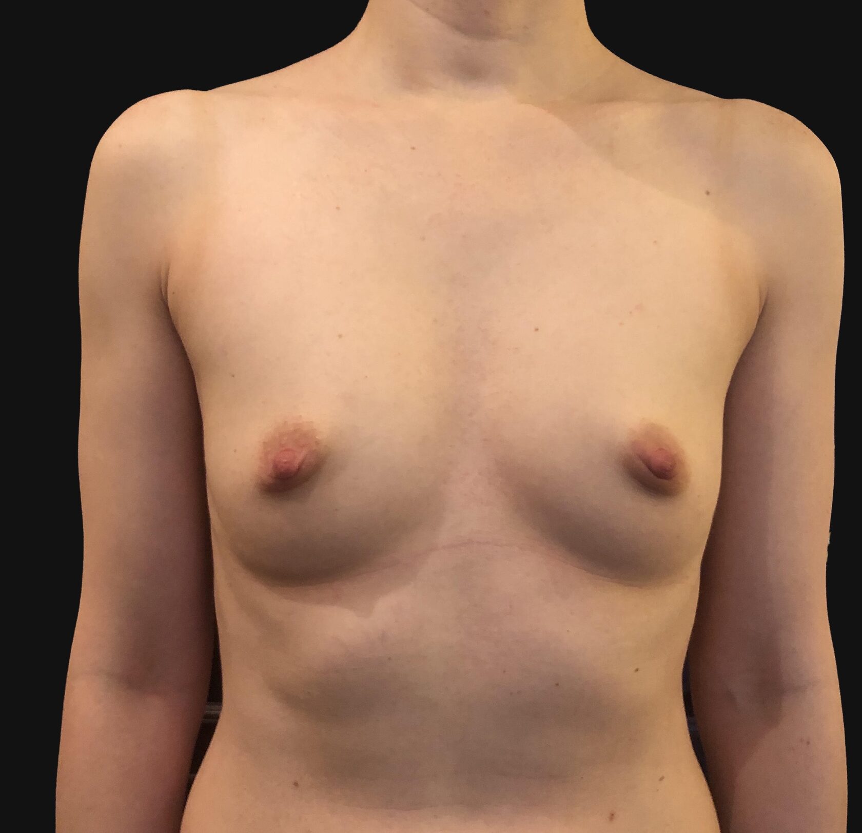 грудь 3 размера на круглых имплантах фото 92