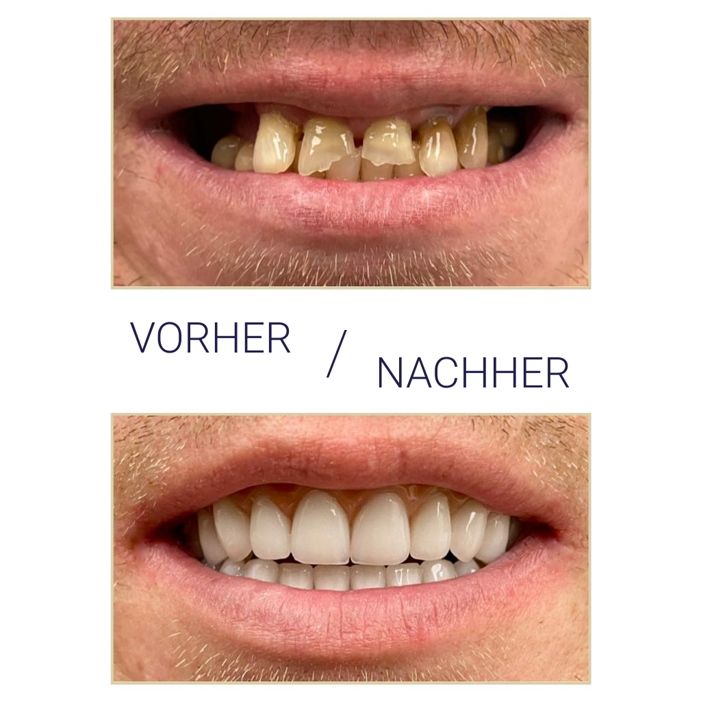 Dental basal Implantation