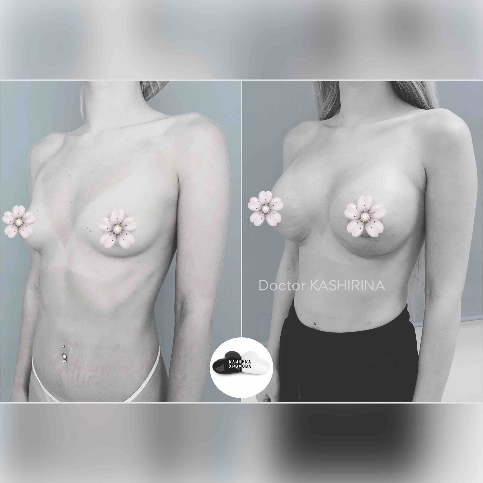 разные импланты на одну грудь фото 15