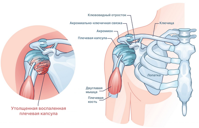 Плечевой периартрит лечение препараты