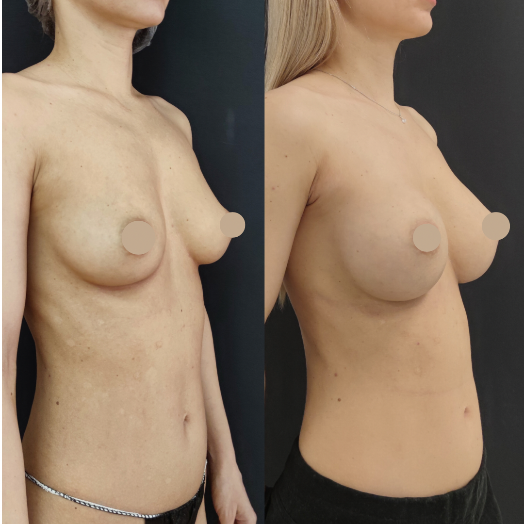 силиконовая грудь круглые импланты фото 58