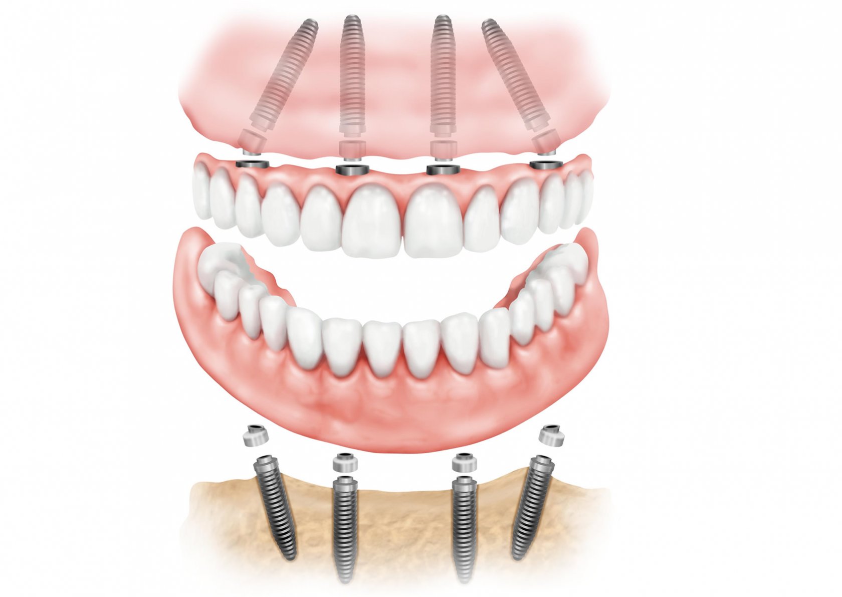 Зубы на 4х имплантах