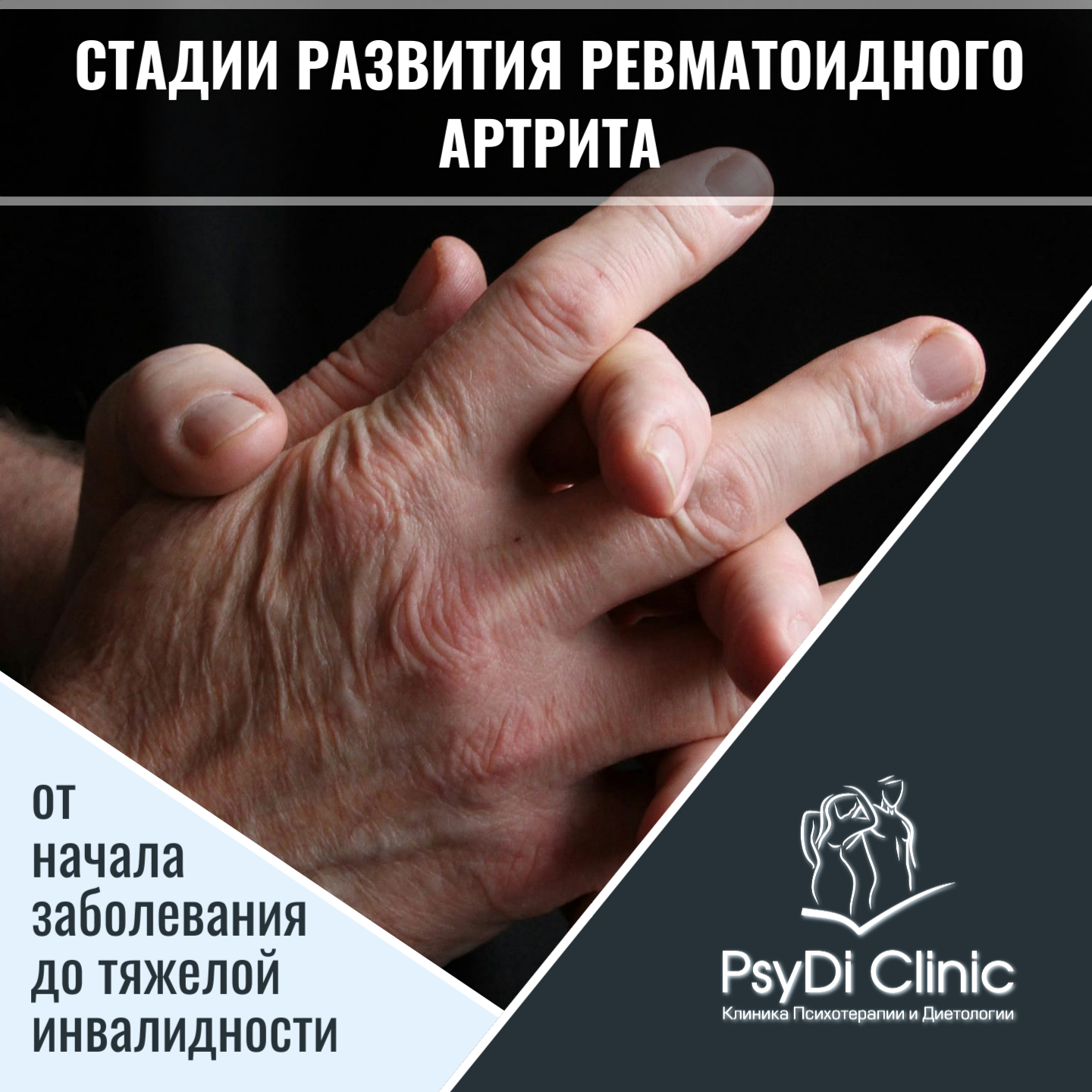 Стадии развития ревматоидного артрита: от начала заболевания до тяжелой инвалидности ��