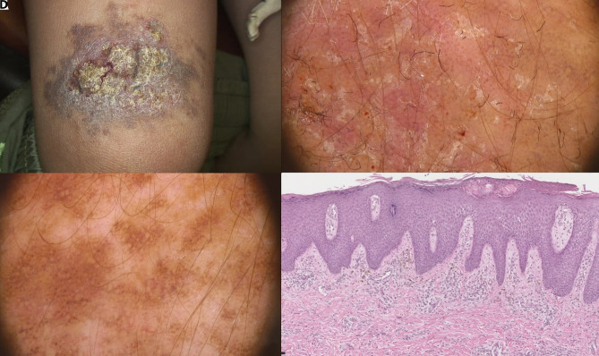 Unilateral linear comedonic nevus