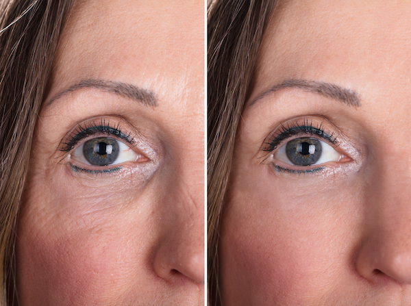 Морщины около глаз: до и после