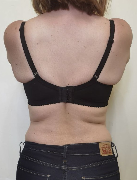 убрать живот и бока без липосакции