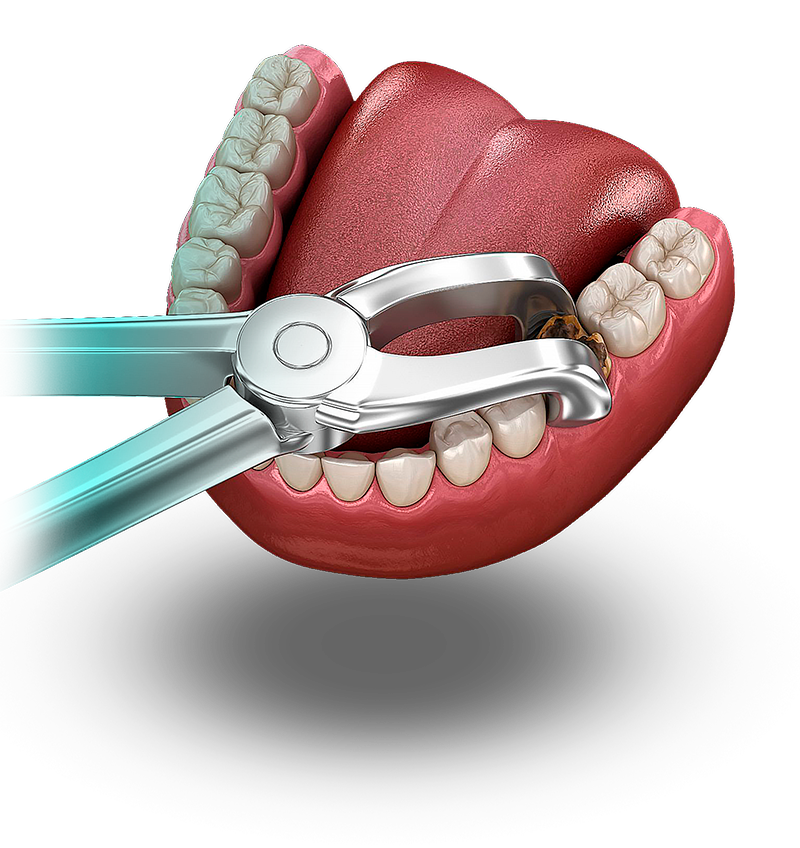 Удаление зубов в Москве, клиника СимплиМед