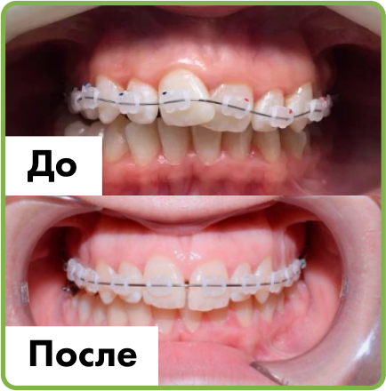 Установка имплантов в Дербенте. Имплантация при отсутствии одного зуба.