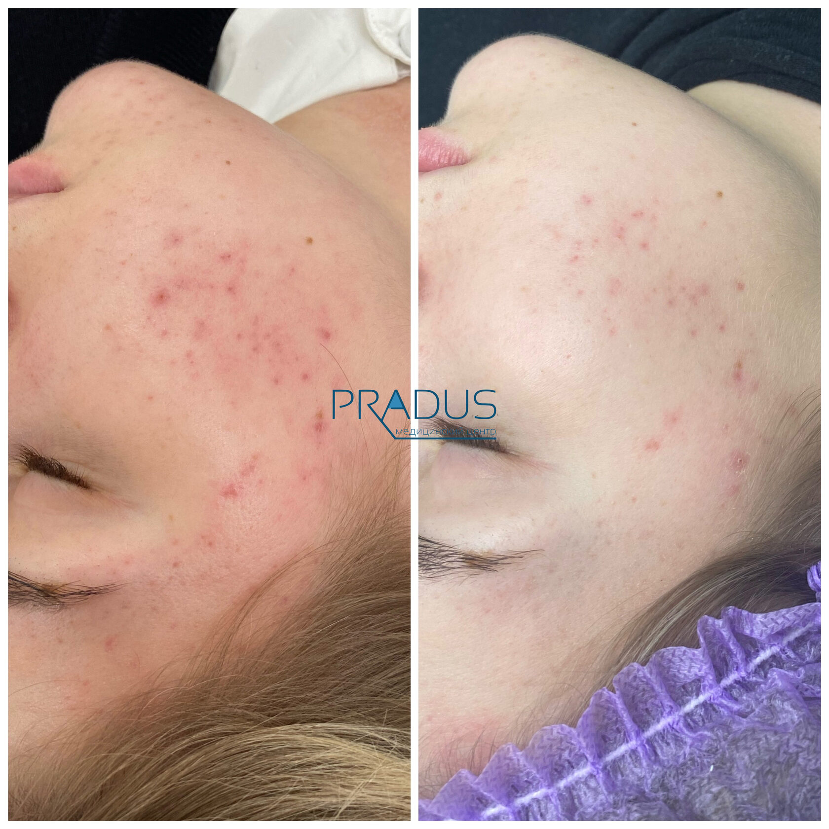 Лечение акне у женщины в клинике PradusCOSMO, СПб. До и после процедуры