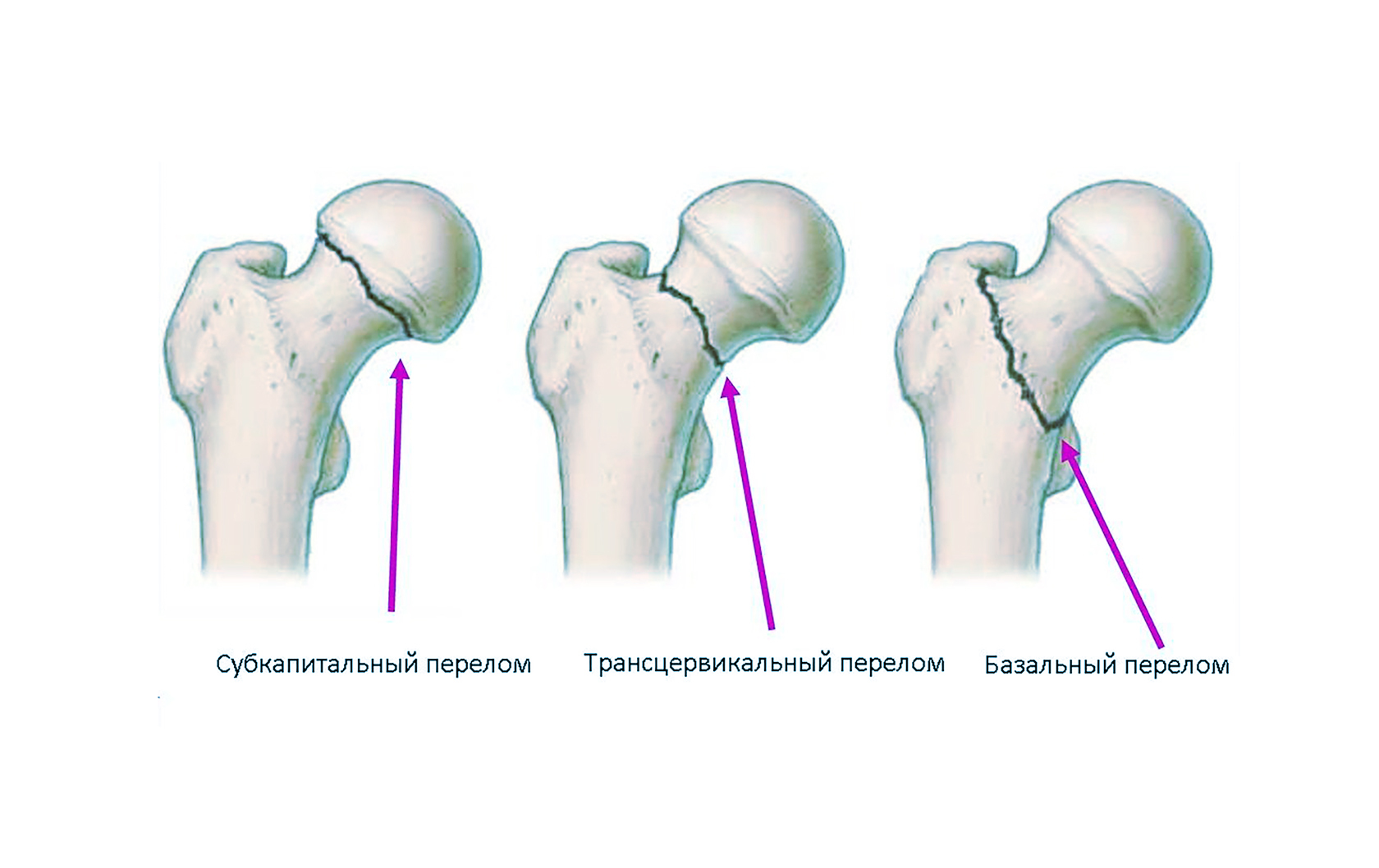Повреждение головки бедренной кости. Повреждение головки бедренной кости. Аваскулярный некроз головки бедренной кости 2 степени. Повреждение головки бедренной кости. Классификация переломов шейки бедренной кости.